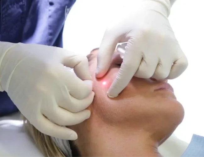 انجام اندولیفت گونه صورت